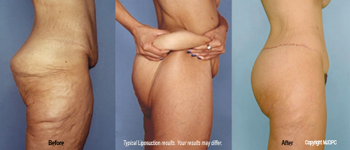 Abs Liposuction Omaha  Omaha Liposuction by Imagen